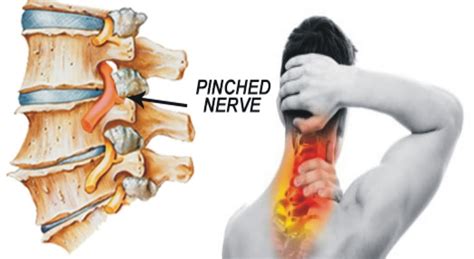 signs of pinched nerve